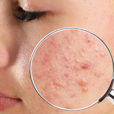 Vanquish Acne in An Effective And Easy Way!